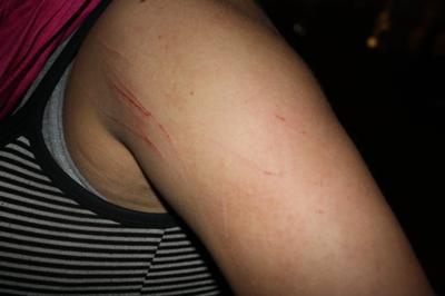 Scratches on Haley's arm